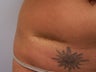Scar Revision with fat transfer