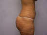 Brazilian Butt Lift