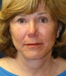 Face Lift, Neck Lift, Upper and Lower Eyelids Rejuvenation