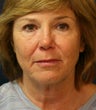 Face Lift, Neck Lift, Upper and Lower Eyelids Rejuvenation