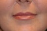 Juvederm in Upper Lip