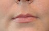 Juvederm in Upper Lip