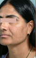 Mesotherapy
