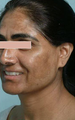 Mesotherapy