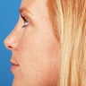 Rhinoplasty