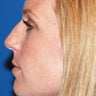 Rhinoplasty