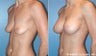 Breast Implants