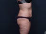 Liposuction Abdomen & Flanks