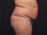 Liposuction Abdomen & Flanks