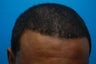 Hair Transplant 2700 Grafts.
