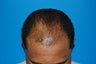 Hair Transplant 2700 Grafts.