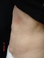 Coolsculpting Abdomen