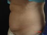 Coolsculpting Abdomen