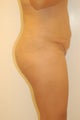 Buttock Enhancement