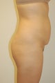 Buttock Enhancement