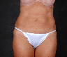 CoolSculpting