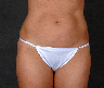 CoolSculpting