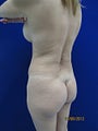 Brazilian Butt Lift