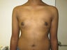 17 year olf male with gynaecomastia