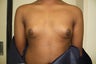 17 year olf male with gynaecomastia