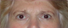 Eyelid Surgery