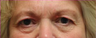Eyelid Surgery