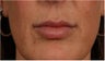 44 year old female with thin lips