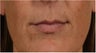 44 year old female with thin lips