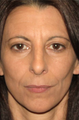 Rhinoplasty