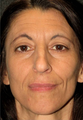 Rhinoplasty