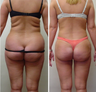 Liposuction