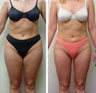 Liposuction