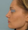 Rhinoplasty