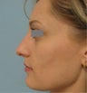 Rhinoplasty