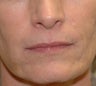 Juvederm