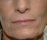 Juvederm