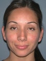 Otoplasty/Ear Surgery
