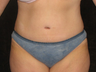 Tummy Tuck