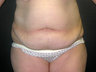 Tummy Tuck