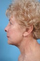 Neck Lift Patient