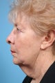 Neck Lift Patient
