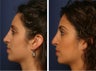 Rhinoplasty Revision