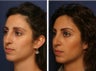 Rhinoplasty Revision