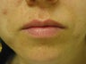 Restylane