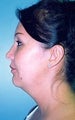 33 year old female patient 