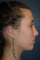 Nose Surgery