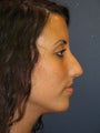 Nose Surgery