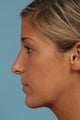 Rhinoplasty