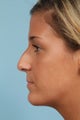 Rhinoplasty