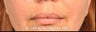Lip Augmentation